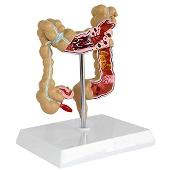 Модель патологического колоректального рака толстой кишки, модель Толстой кишки, Анатомическая модель желудочно-кишечного тракта